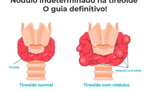 Nodulo na tireoide